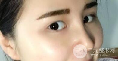 鼻子整形恢复过程真人案例