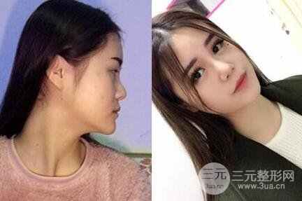 鼻子整形恢复过程真人案例