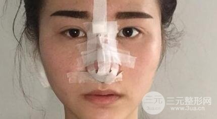 鼻子整形恢复过程真人案例