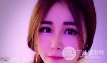 鼻子整形恢复过程真人案例