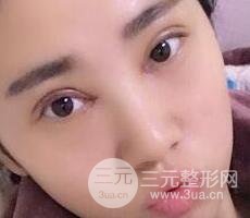切开双眼皮+开内眼角案例