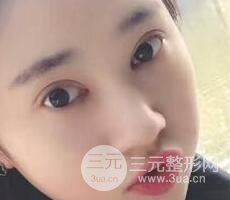 切开双眼皮+开内眼角案例