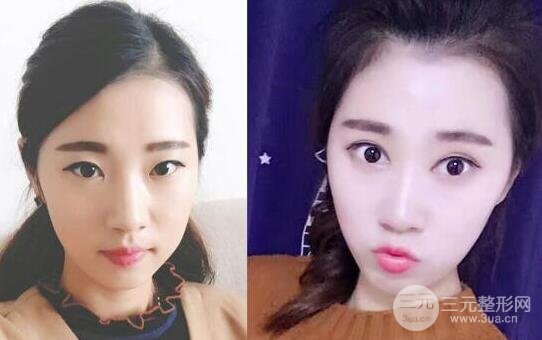 切开双眼皮+开内眼角案例