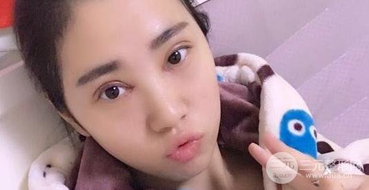 切开双眼皮+开内眼角案例