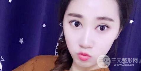 切开双眼皮+开内眼角案例