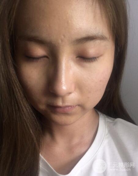 注射水光补水价格和案例图片