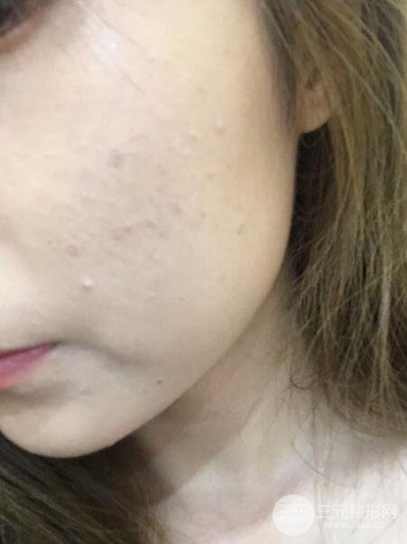 注射水光补水价格和案例图片