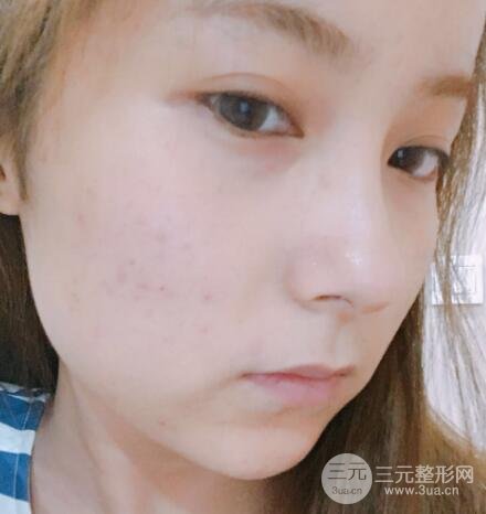 注射水光补水价格和案例图片