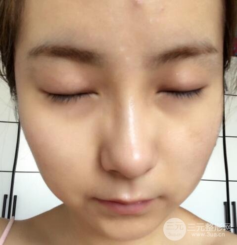 注射水光补水价格和案例图片