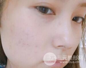 注射水光补水价格和案例图片