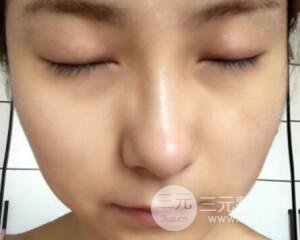 注射水光补水价格和案例图片