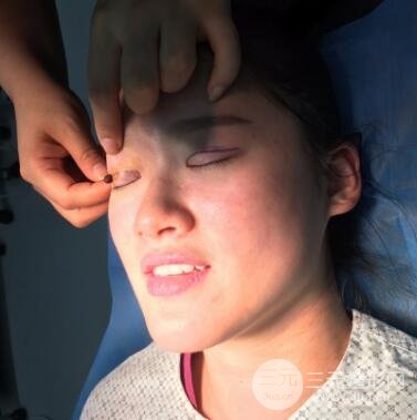 三点定位双眼皮整形恢复图案例