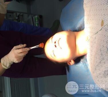 三点定位双眼皮整形恢复图案例