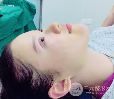 三点定位双眼皮整形恢复图案例