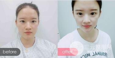 三点定位双眼皮整形恢复图案例