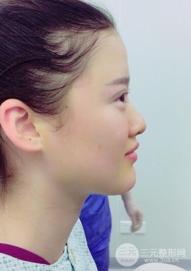 三点定位双眼皮整形恢复图案例