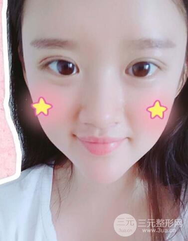 三点定位双眼皮整形恢复图案例