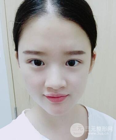 三点定位双眼皮整形恢复图案例