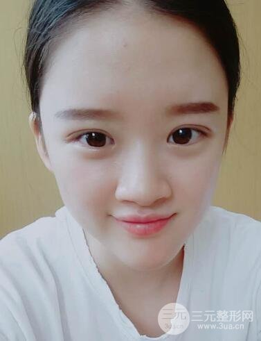 三点定位双眼皮整形恢复图案例