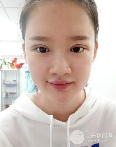 三点定位双眼皮整形恢复图案例