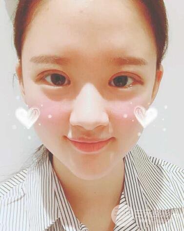 三点定位双眼皮整形恢复图案例