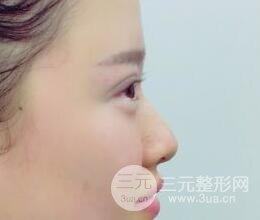 三点定位双眼皮整形恢复图案例