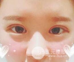 三点定位双眼皮整形恢复图案例