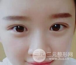 三点定位双眼皮整形恢复图案例