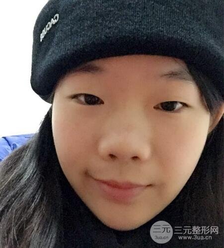 硅胶隆鼻+耳软骨垫鼻尖+鼻小柱延长案例