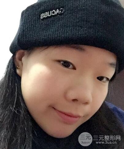 硅胶隆鼻+耳软骨垫鼻尖+鼻小柱延长案例