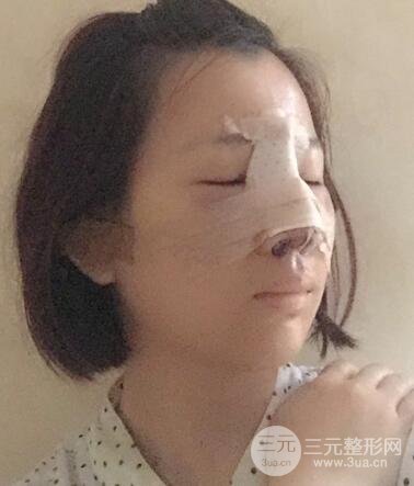硅胶隆鼻+耳软骨垫鼻尖+鼻小柱延长案例