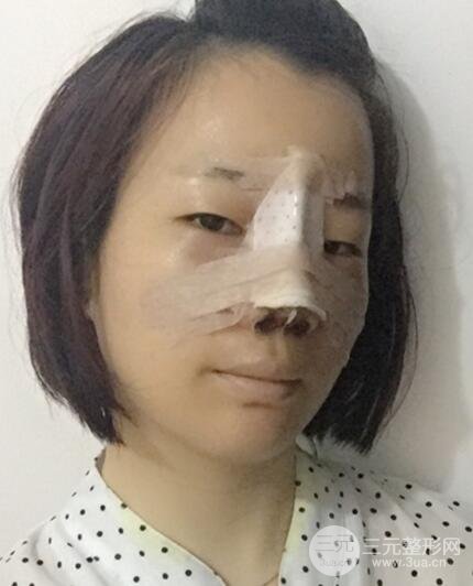 硅胶隆鼻+耳软骨垫鼻尖+鼻小柱延长案例