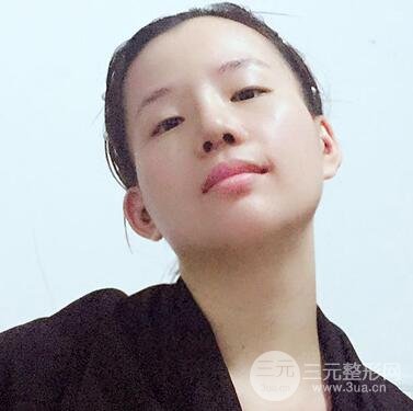 硅胶隆鼻+耳软骨垫鼻尖+鼻小柱延长案例