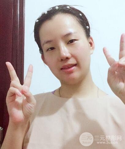 硅胶隆鼻+耳软骨垫鼻尖+鼻小柱延长案例