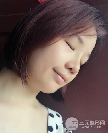 硅胶隆鼻+耳软骨垫鼻尖+鼻小柱延长案例