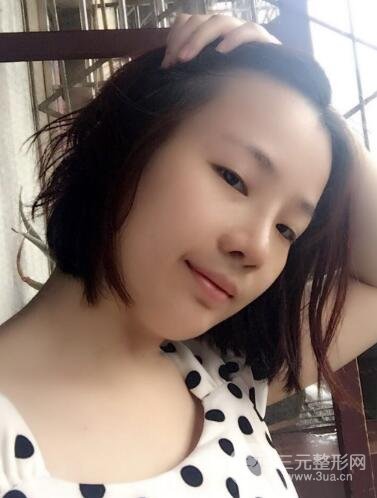 硅胶隆鼻+耳软骨垫鼻尖+鼻小柱延长案例