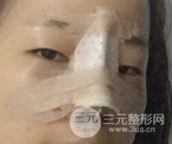 硅胶隆鼻+耳软骨垫鼻尖+鼻小柱延长案例