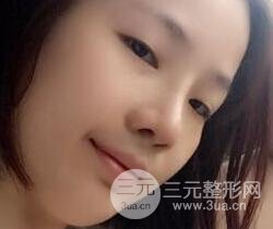 硅胶隆鼻+耳软骨垫鼻尖+鼻小柱延长案例