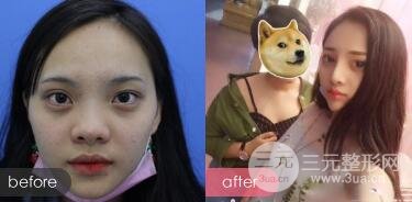 上海鼻子整形专家、价格和案例