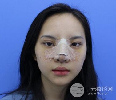 上海鼻子整形专家、价格和案例