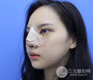 上海鼻子整形专家、价格和案例