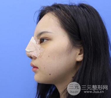 上海鼻子整形专家、价格和案例