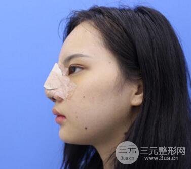 上海鼻子整形专家、价格和案例