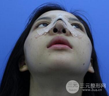 上海鼻子整形专家、价格和案例