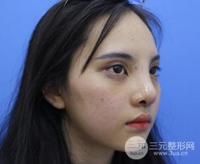 上海鼻子整形专家、价格和案例