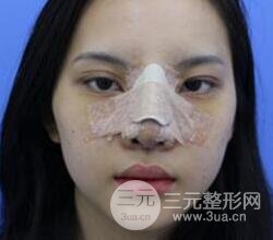 上海鼻子整形专家、价格和案例
