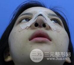 上海鼻子整形专家、价格和案例