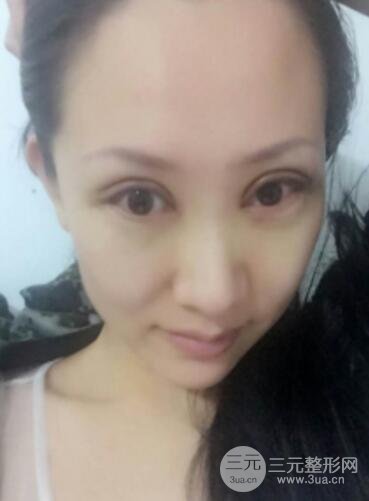 双眼皮修复术价钱和案例图