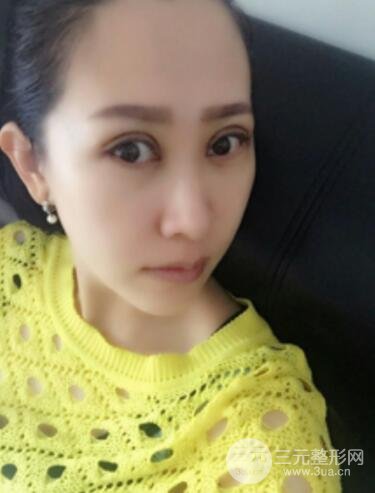 双眼皮修复术价钱和案例图