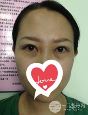 双眼皮修复术价钱和案例图